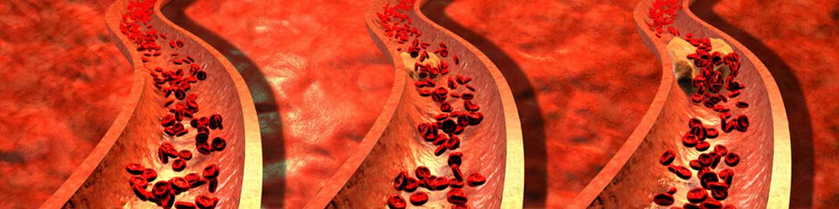 High Cholesterol or Hypercholesterolemia